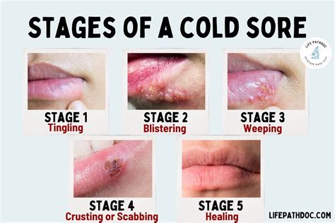 photos of cold sore stages